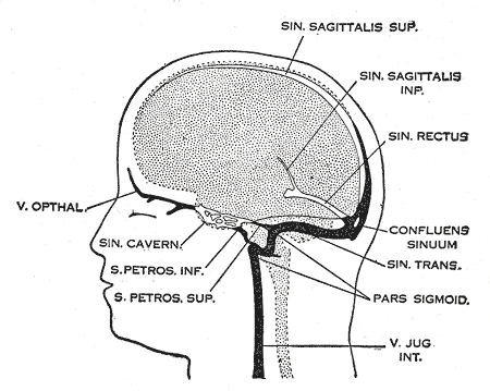 Cerebral venous sinus thrombosis