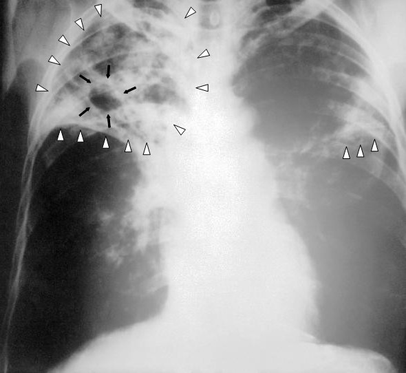 Tuberculosis